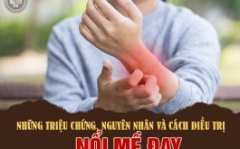 Nổi mề đay