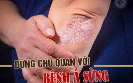 Đừng chủ quan với bệnh á sừng