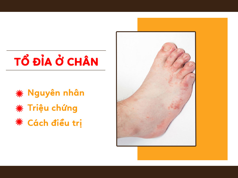 Bệnh tổ đỉa ở chân