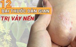 Cách trị vảy nên dân gian