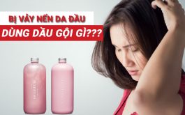 Dầu gội trị vảy nến da đầu