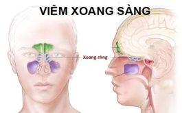 Hình ảnh viêm xoang sàng