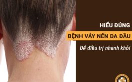 bệnh vảy nến da đầu