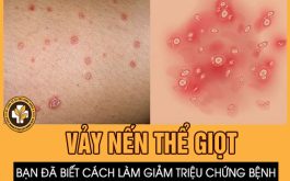 Vảy nến thể giọt