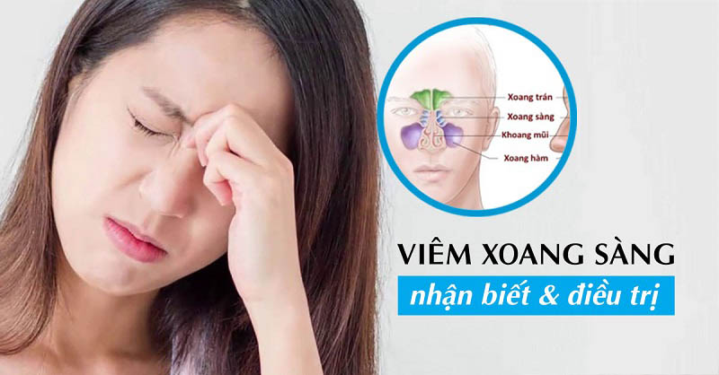 Viêm xoang sàng trước, sau