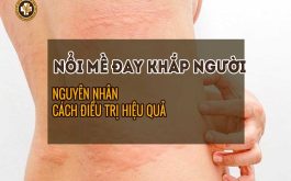 Nổi mề đay khắp người