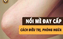 Mề đay cấp