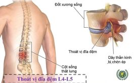 Thoát vị đĩa đệm L4 L5