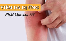 Viêm da dị ứng là bệnh gì? Gồm những loại nào? Có nguy hiểm không? Điều trị bằng cách nào?