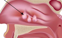 Viêm xoang có polyp mũi là tình trạng thoái hóa mô mềm tại niêm mạc mũi