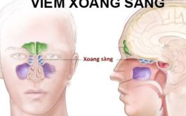 Viêm xoang sàng sau có chữa được không