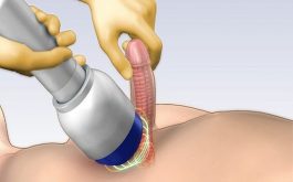 Tổng hợp những cách chữa liệt dương hiệu quả nhất bạn nên biết