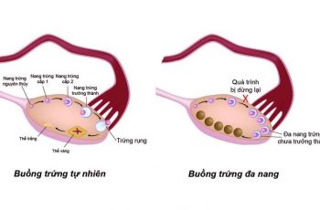 Hình ảnh buồng trứng đa nang