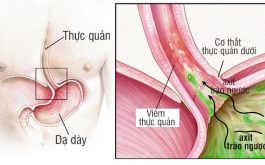 Nguyên nhân gây trào ngược do cơ thực quản dưới bị suy yếu