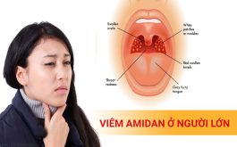 Viêm amidan ở người lớn - Nguy hiểm, Đừng xem nhẹ!