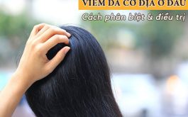 Bị viêm da cơ địa ở đầu - Phải điều trị như thế nào?