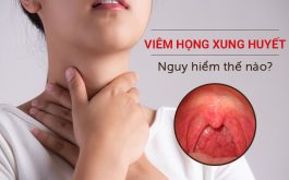 Viêm họng xung huyết - Nguy hiểm không thể bỏ qua