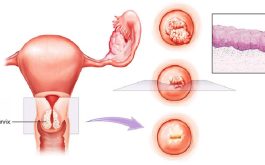 viêm lộ tuyến tái tạo cổ tử cung là gì