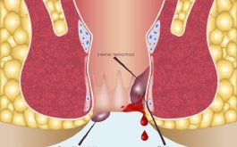 Kích thước của búi trĩ sẽ tăng dần lên và không thể co lại vào bên trong, gây nhiều hệ lụy nguy hiểm.