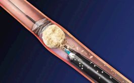 Bắn laser sỏi thận là phương pháp trị sỏi được áp dụng phổ biến hiện nay