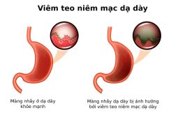 Xét nghiệm Hp âm tính, vì sao vẫn bị viêm teo dạ dày?