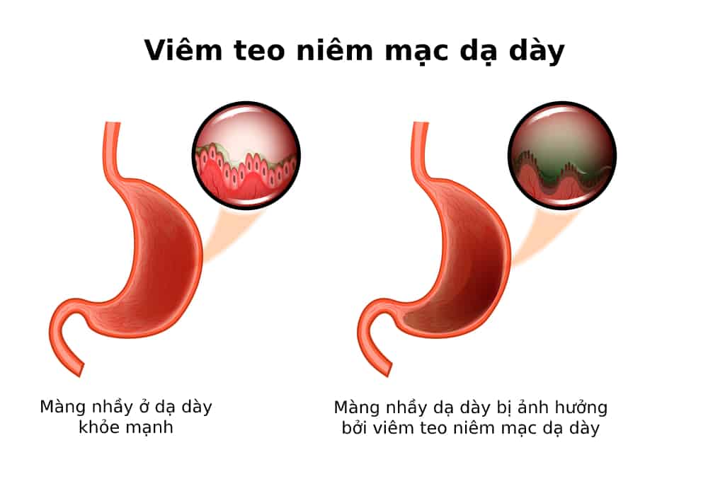 Xét nghiệm Hp âm tính, vì sao vẫn bị viêm teo dạ dày?