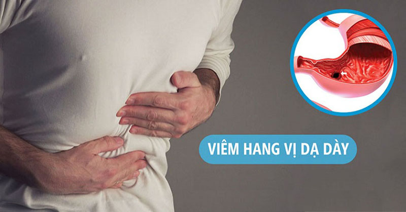 Nếu không được phát hiện, điều trị kịp thời, viêm hang vị dạ dày có thể phát triển thành ung thư