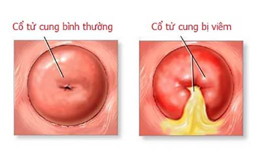 Viêm cổ tử cung và các biến chứng của bệnh - Viêm cổ tử cung và các biến chứng của bệnh