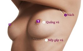 Chi phí nâng ngực nội soi là bao nhiêu