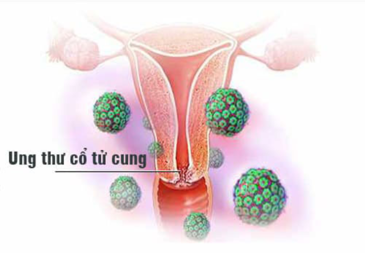 Các giai đoạn phát triển của ung thư Cổ tử cung do nhiễm HPV