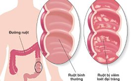 Viêm loét đại tràng