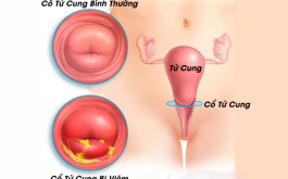 Viêm cổ tử cung: Nguyên nhân và triệu chứng cảnh báo | Vinmec