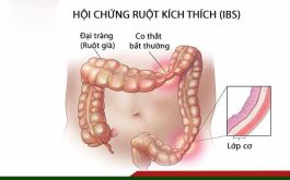 Ăn sữa chua giảm các triệu chứng hội chứng ruột kích thích (IBS)