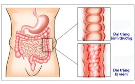 Bệnh viêm đại tràng: nguyên nhân, triệu chứng và điều trị | Medlatec