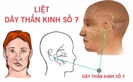 Liệt dây thần kinh số 7 phải điều trị trong bao lâu?