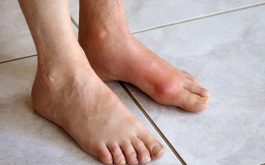 Các giai đoạn của bệnh gout và triệu chứng bệnh gout sớm | Medlatec