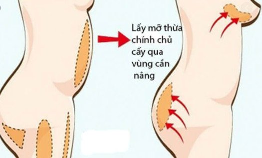 Các phương pháp nâng mông