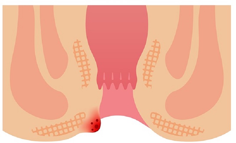 Top 7 dấu hiệu bệnh trĩ ngoại dễ nhận biết nhất | Medlatec