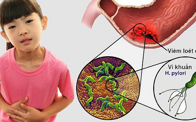 Viêm loét dạ dày tá tràng ở trẻ em tăng cao