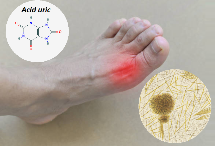 Giải đáp thắc mắc: Chỉ số acid uric 530 là cao hay thấp, đã bị gút hay chưa?