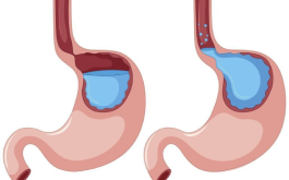 Trào ngược dạ dày: Các nguyên nhân gây bệnh và cách phòng ngừa