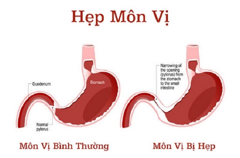 Hẹp môn vị khiến khả năng vận chuyển thức ăn bị cản trở gây nguy hiểm cho người bệnh