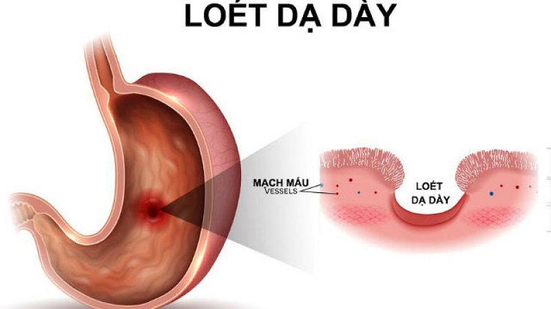 Bệnh đau bao tử cấp độ 2 - loét dạ dày