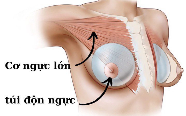 Chăm sóc hồi phục sau phẫu thuật nâng ngực 