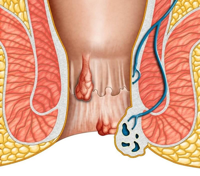 Bệnh lòi dom có liên quan tới vùng hậu môn và trực tràng khiến không ít người nhầm lẫn giữa khái niệm lòi dom và bệnh trĩ.