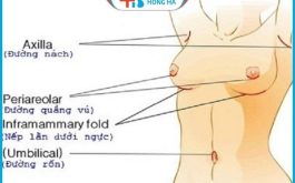 Nâng ngực đường nào tốt nhất hiện nay được nhiều người quan tâm