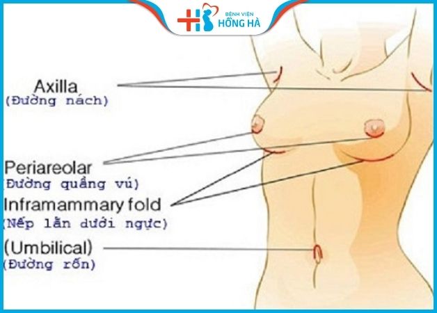 Nâng ngực đường nào tốt nhất hiện nay được nhiều người quan tâm