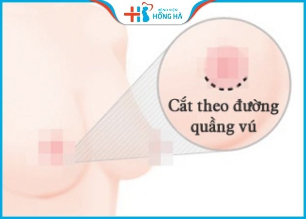 Nâng ngực đường quầng vú dễ làm mất cảm giác đầu ngực