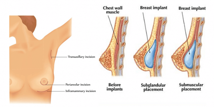 Nâng ngực có được bóp mạnh không-hình 3