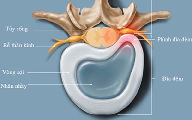 Cấu tạo đĩa đệm và tình trạng phồng đĩa đệm